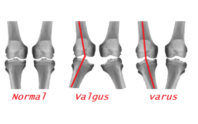 Varus and Valgus deformities. What are they and how do they affect me?